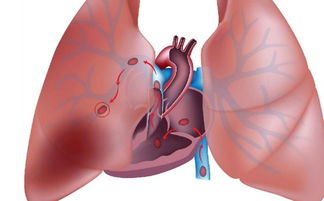 如何诊断肺栓塞疾病