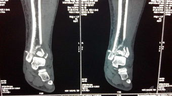 左小腿胫腓骨骨折图片 图片信息欣赏 图客 Tukexw Com