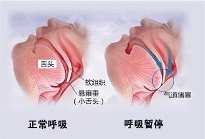 舌头肥大是什么原因 舌头疼肥大有齿印没舌苔反反复疼，是什么原因？ 