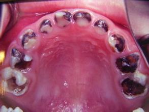 介绍一下龋齿的基本症状
