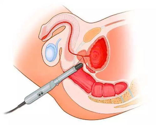 前列腺常规检查怎么做