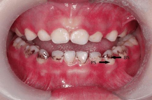 出现了龋齿 牙齿需要早期矫正 儿童口腔问题,你应该知道的那些事儿