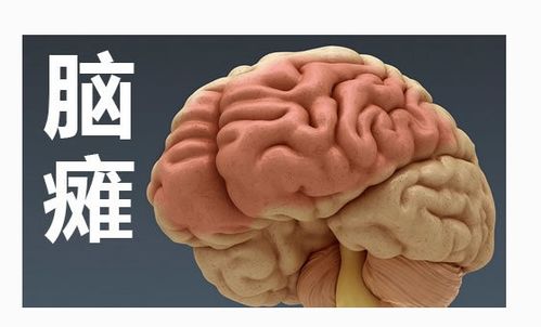 什么是脑瘫 成都儿童脑瘫医院的专家门诊是哪