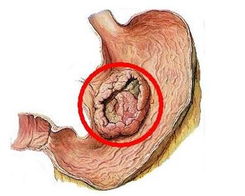 胃癌的早期症状饮食,早期胃癌的症状