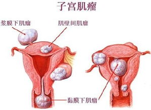 子宫肌瘤会造成不孕吗 