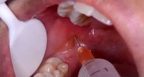 口腔外科拔牙时是要进行局部麻醉的,请问浸润麻醉和阻滞麻醉有什么区别啊?分别在什么情况下用的?