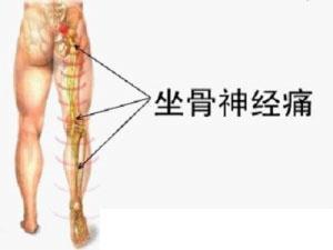 腿疼的厉害 腰并没有感觉疼是腰椎间盘突出吗