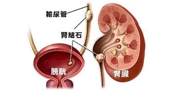 男子爱吃豆腐长420颗肾结石 医生夹得手脚发麻 