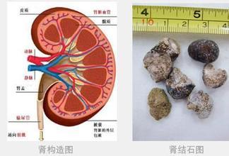 肾结石多大需要手术