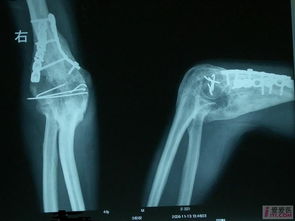 肘关节骨折术后骨化性肌炎 多图
