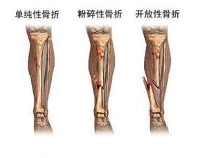 医生,我可以不打石膏吗