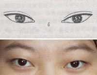 哪些眼型适合做韩式双眼皮 
