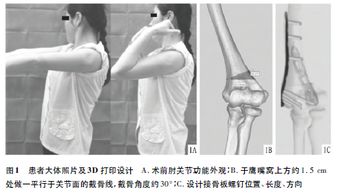 3D打印技术指导下楔形截骨治疗成人肘内翻1例 