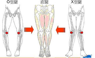 宝宝学步应循序渐进,过早站立或至O型腿内八字