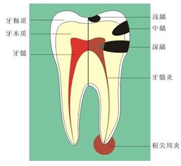 牙齿疼过一阵子后又不疼了,是恢复好了吗