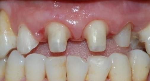 牙齿瘘管，关于“牙龈瘘管”我的情况有点特别,麻烦专家看看!
