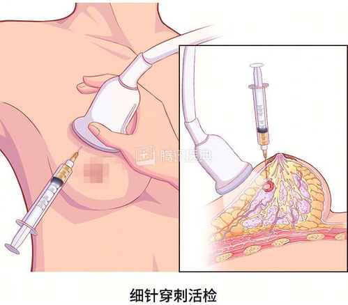 医生让做的 活检 ,到底是什么