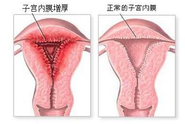 泰国试管婴儿移植,子宫内膜多厚最佳,看优孕行怎么说