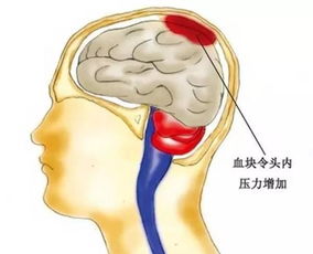 脑出血是怎么产生的