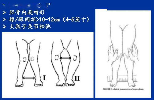 健康一点点 矫正腿型你做错了