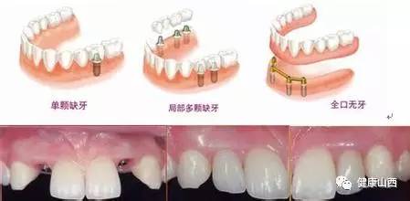 不是所有人都适合种植牙 这5类人要做种植牙 别,那是有人忽悠你 