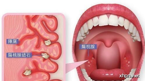 喉咙里有异物感是怎么回事(感冒后喉咙里有异物感是怎么回事)