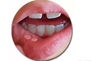 消除口腔溃疡的护理方法要熟知