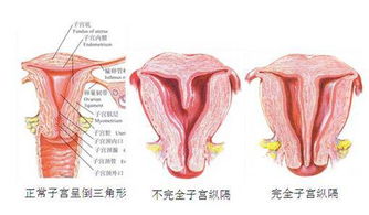 子宫不完全纵膈 子宫不完全纵膈 是否可以通过宫腔镜手术解决