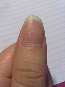 大拇指指甲凹凸不平 有3年了 手指无其他状况 