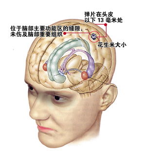 一块花生米大小的弹片 脑中 呆 了59年后才发现 