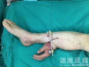 断手 种 小腿 湘雅寄养回植手术再获成功 