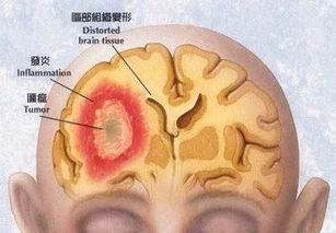 脑瘤的早期症状头晕 大肠癌早期会有哪些症状？如何预防大肠癌？ 