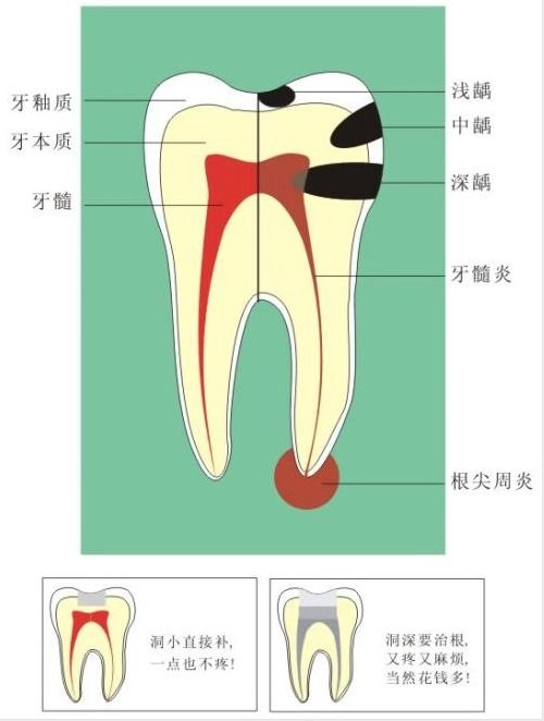 中,備洞的**或者材料的**引起牙齒冷熱水**痛,要觀察一週至兩週,症狀