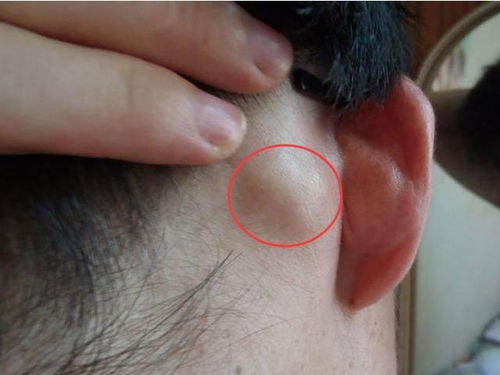 耳朵后面长了个硬包是是什么 竟是一种病 