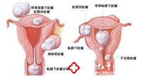 严重宫颈息肉的危害 