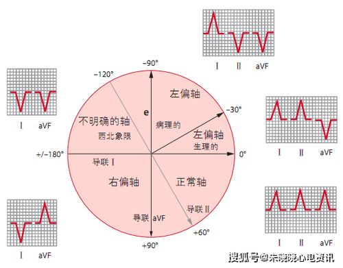 10分钟掌握标准心电图的基础知识