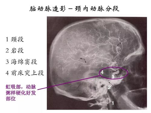 脑血管解剖定位