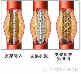 行善堂 心脏支架 支不起生命,架不了健康