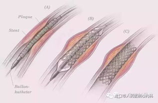 心脏支架手术那些事3 支架术前必知的 潜规则