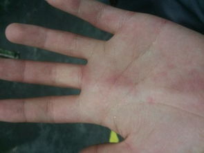 手上皮肤里长红斑先在手心有时候会淡下去有时候又特别明显,手指和手背上也有一点主要还是手掌上有时痒痛 