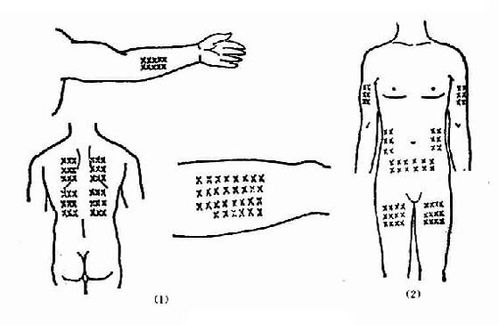 皮下针注射方法和位置,皮下针注射方法和位置图片