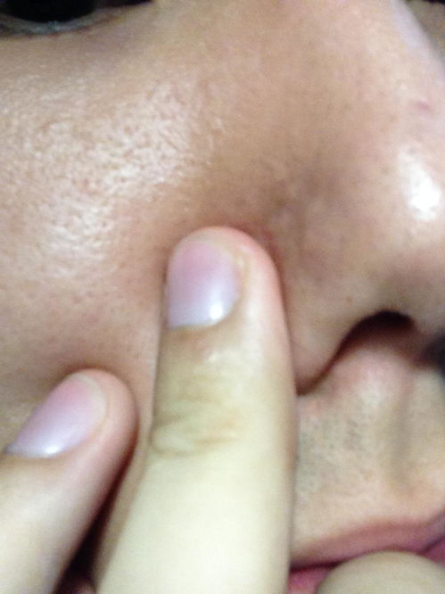 鼻子上的增生性凸起痘印能去除吗 怎么去除 