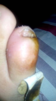 小脚趾头红肿 是不是灌浓了 非常疼痛 