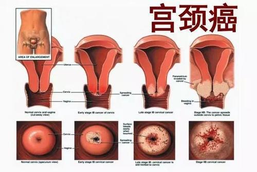 感染hpv最多能活五年吗 年轻的话能不能治好