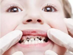 牙龋病 龋齿是怎样形成的