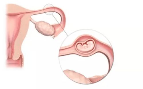 宫外孕会有出现哪些信号？做试管婴儿可以避免宫外孕吗？