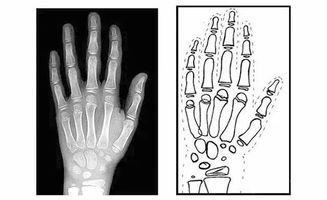 骨龄提前影响孩子长高 沈阳盛京医院小儿生长发育科赵亚茹主任告诉你该怎么正确测骨龄
