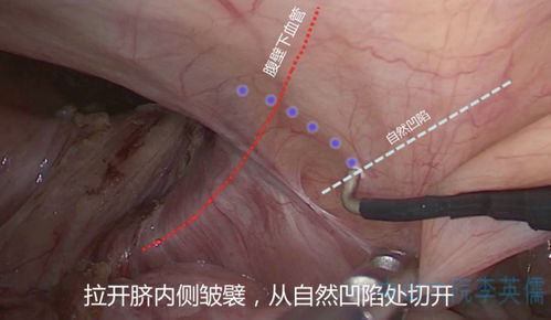 TAPP 很难 其实学会这 7 步就能搞定