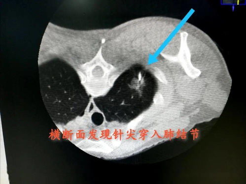 考虑肺癌,建议肺组织活检 医师报告的这一条肺部诊断在临床中是如何实际操作的 病理科 