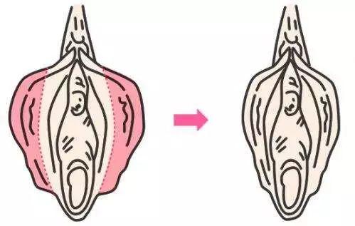 私密整形 那些年被 阴唇肥大 困扰的女孩